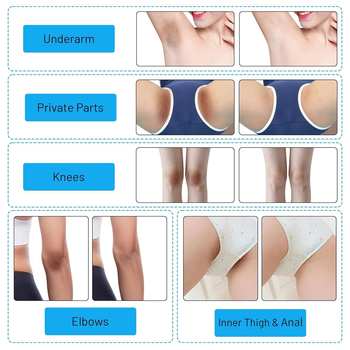Skin Whitening Cream Bleaching Cream for Body Intimate Area, Private Parts, Underarm, Knees, Elbows, Inner Thigh, Bikini Areas, Bikini Line, Skin Lightening Dark Spot Remover for Intimate Areas 60ML